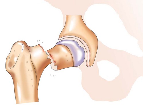 Часты случай-патологический перелом шейки бедра