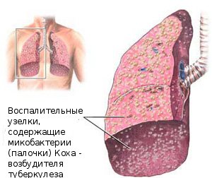 Палочки Коха