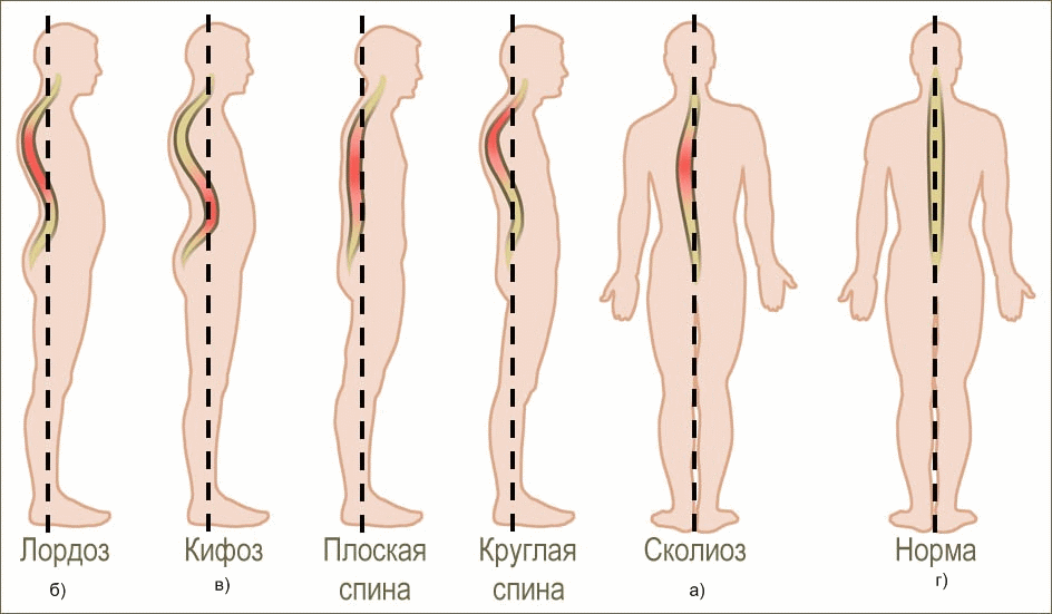 типичные виды нарушения осанки