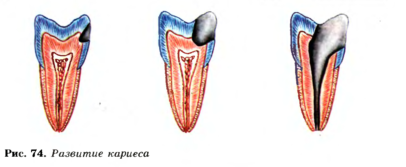 Развитие кариеса